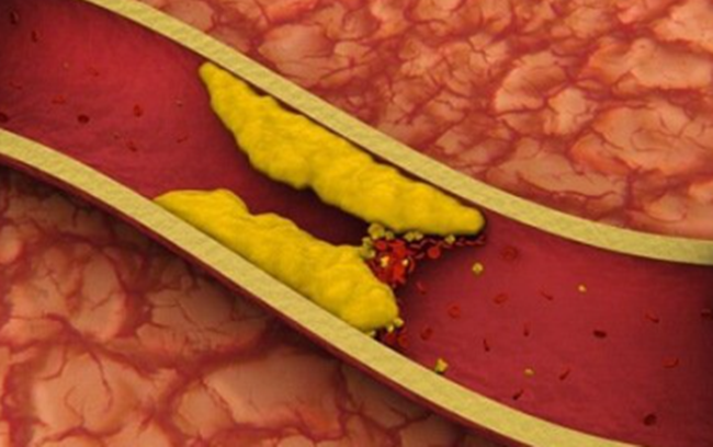 콜레스테롤 높으면 나타나는 증상
