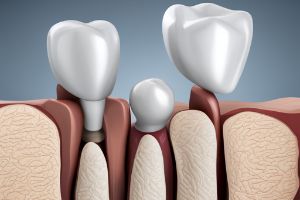 용인시-수지구-임플란트-치과-가격-비용-싼-곳&amp;#44;저렴한-곳&amp;#44;잘하는-곳&amp;#44;유명한-곳-BEST20-추천4