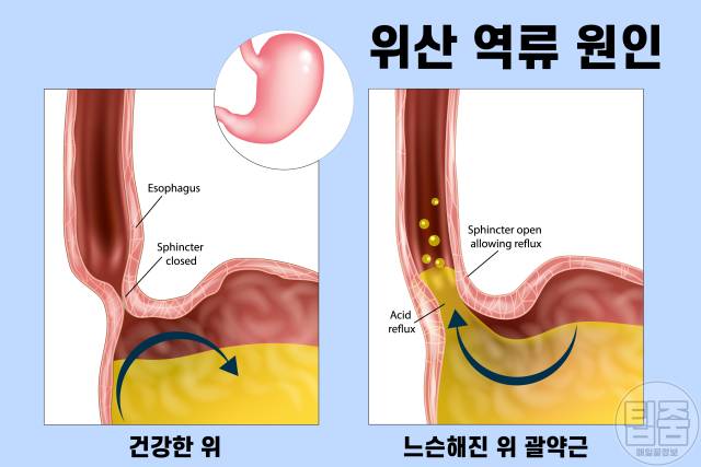 역류성식도염 증상 자연치료 방법 6가지