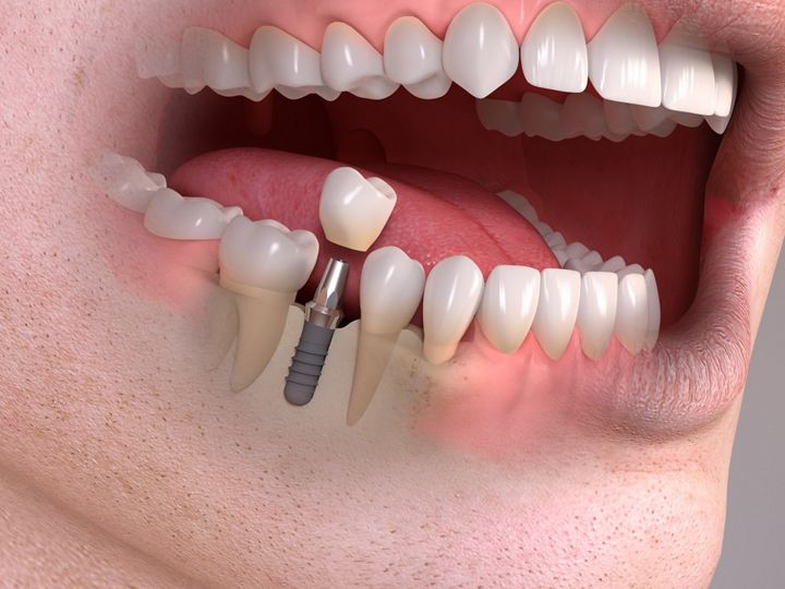 임플란트 종류와 회사 선택, 기간, 수술, 뼈이식