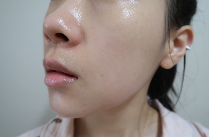 bbl 레이저 후기