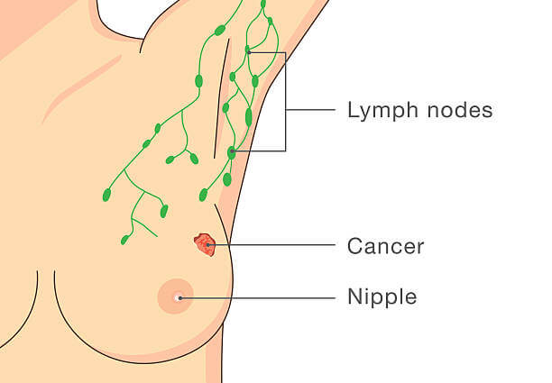 겨드랑이 멍울&amp;#44; 통증 원인 및 예방법입니다. 멍울로 인한 통증과 불편함은 상당히 심각한 문제일 수 있습니다. 하지만 걱정하지 마세요. 이 글에서는 겨드랑이 멍울의 원인과 예방법&amp;#44; 그리고 치료 방법을 알려드리겠습니다. 이제부터 멍울 걱정은 이제 그만! 겨드랑이 건강을 지켜보세요.