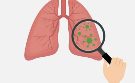 식도암 초기증상 32
