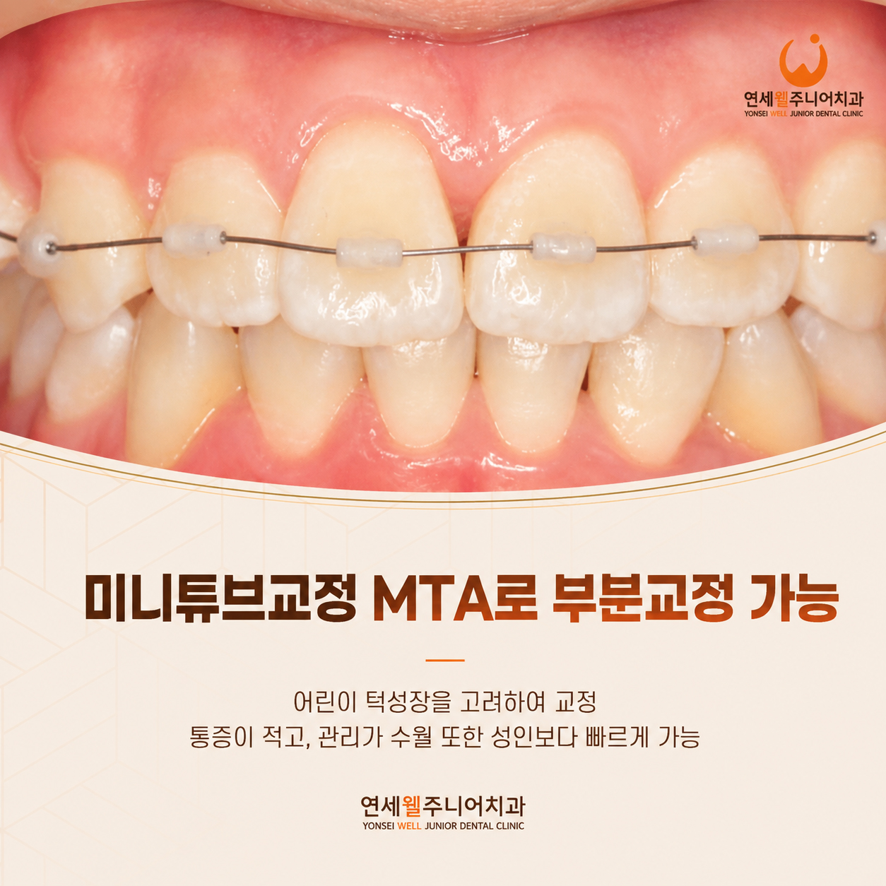 어린이 치아교정에 사용하는 MTA 미니튜브 교정장치로 앞니 부분교정을 진행하는 모습