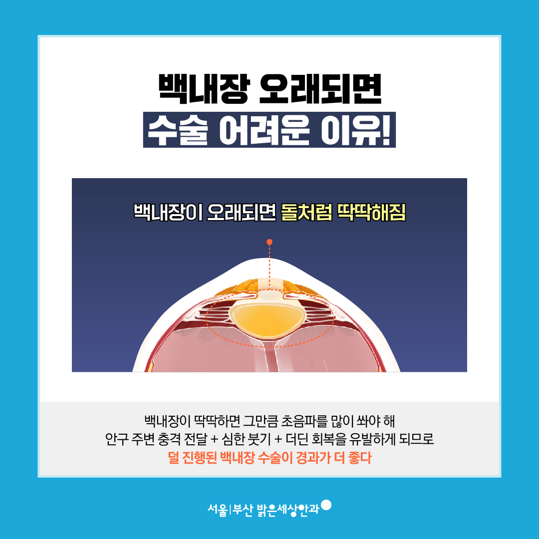 백내장 수술 안내사진