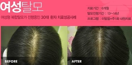 탈모 초기모습과 치료