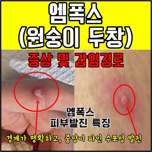 엠폭스 원숭이 두창 피부발진 모습