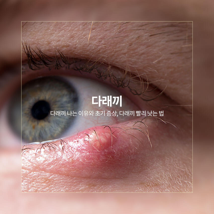 “다래끼-나는-이유와-초기-증상-빨리-낫는-법”
