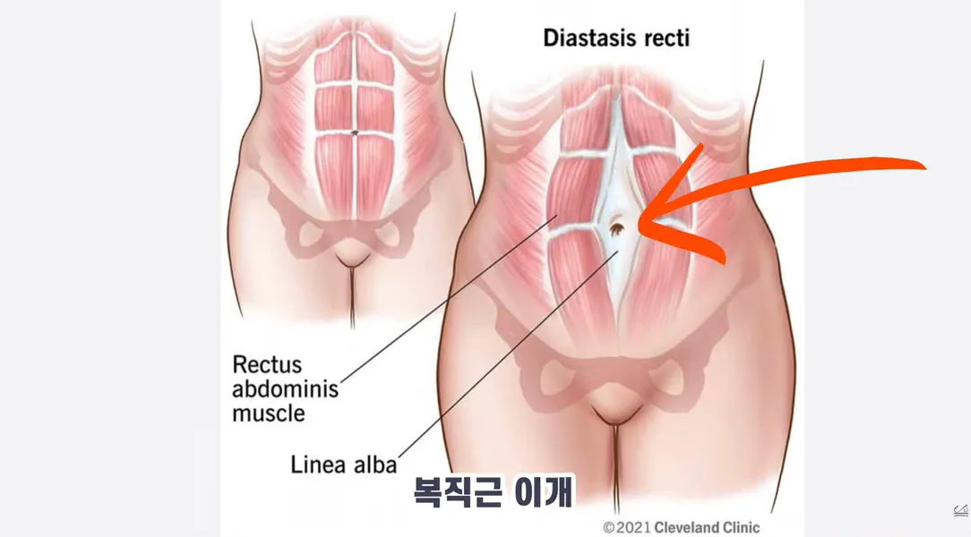 출산후-복직근이개-설명사진