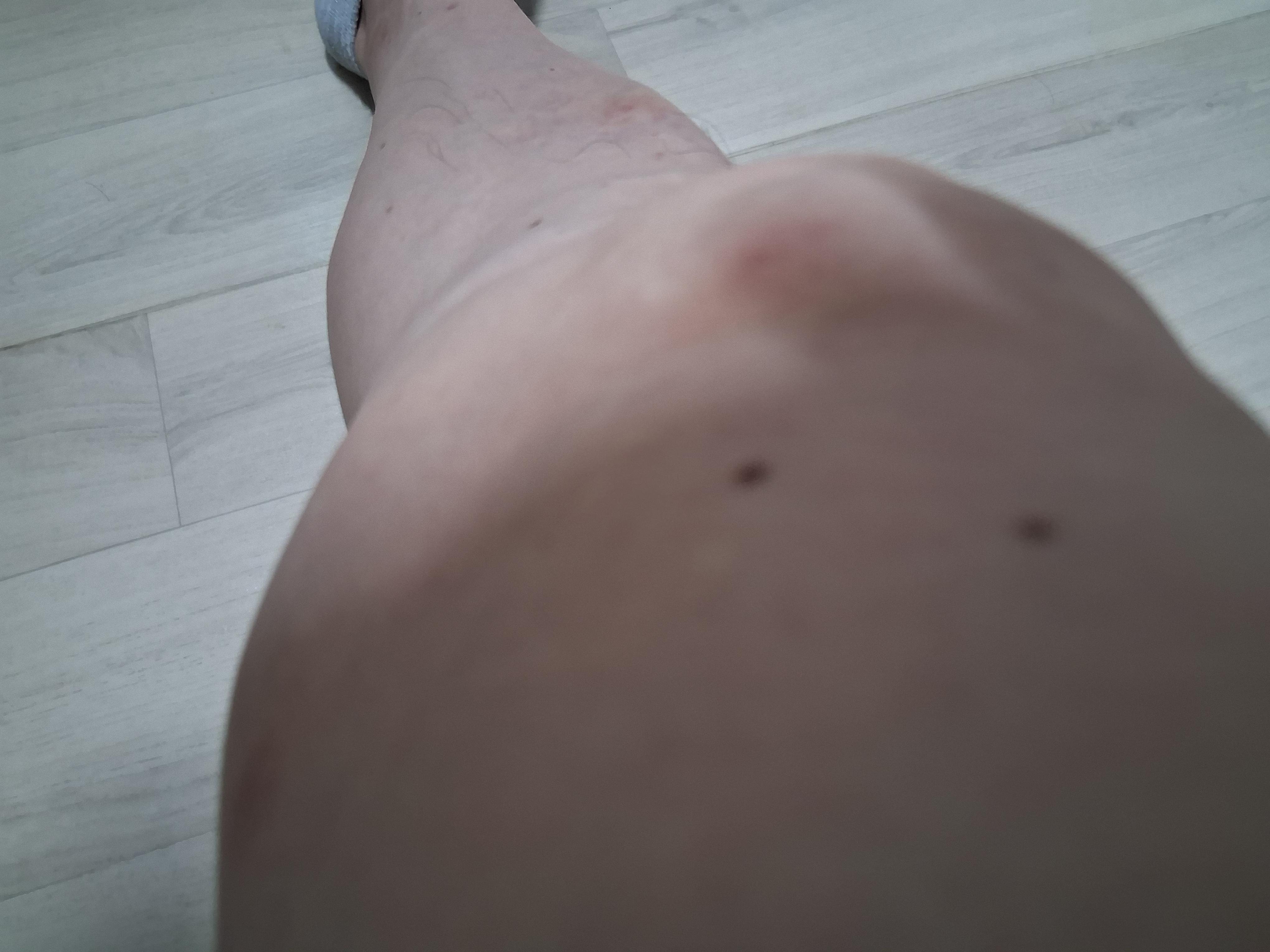 응급처치 후 진정된 다리의 모기 자국들