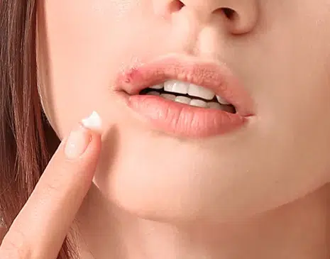 아시클로버 연고