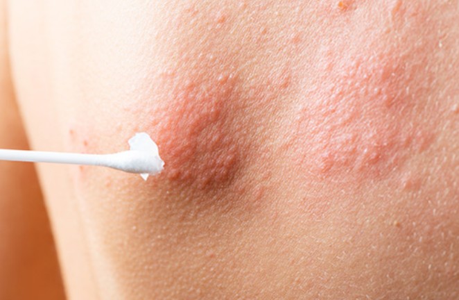 대상포진 초기증상