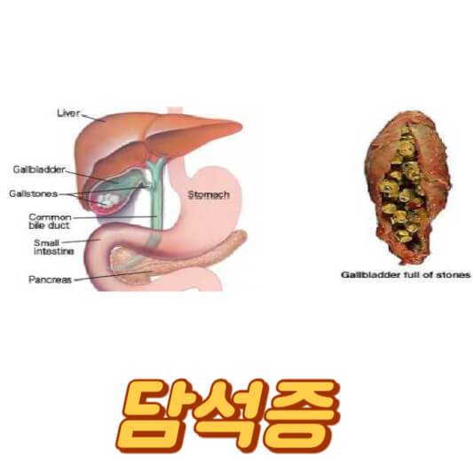 담석증
