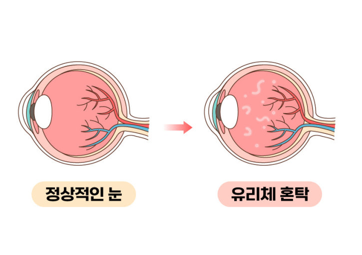비문증 증상과 원인, 치료방법