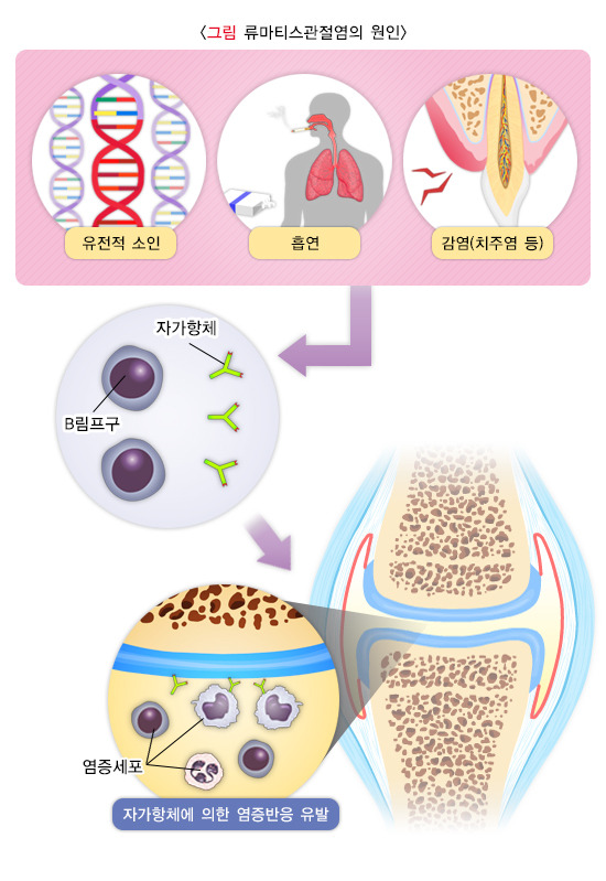 류마티스관절염-자가진단법