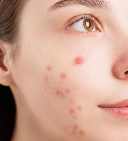 여드름 빨리 없애는 법 원인 증상