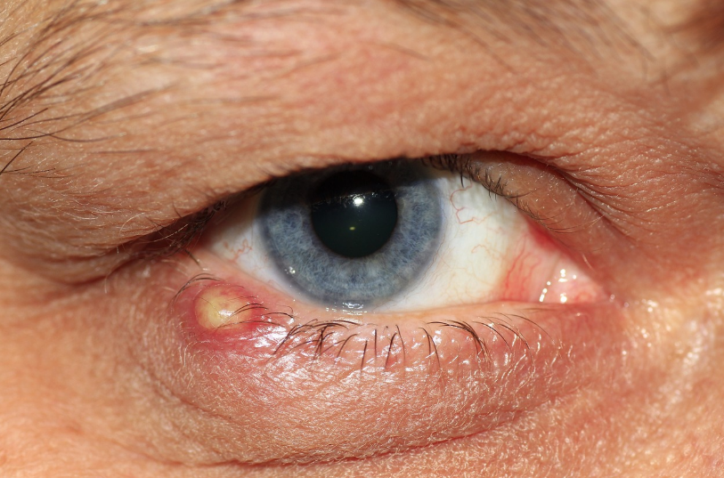 안와장애에서 눈 염증 관련 사진