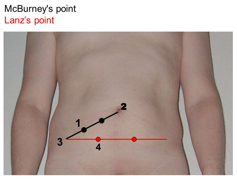 맹장위치-맥버니-란츠-맹장염-충수염