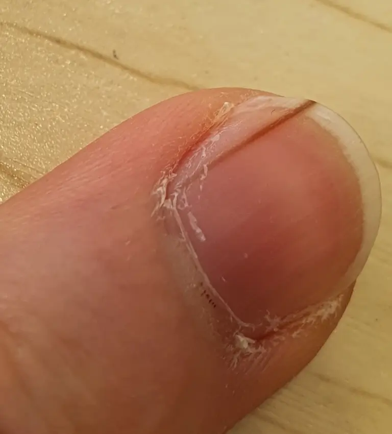 손톱에 검은 세로줄이 생기는 이유