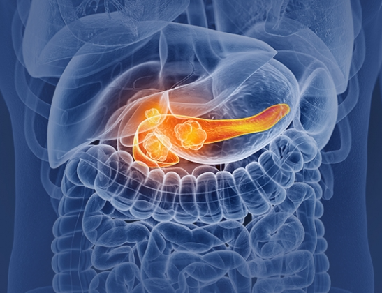 췌장암 초기증상 췌장암치료 항암치료 수술사례 당뇨악화 체중감소 조기발견 건강검진 암극복