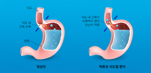역류성 식도염 음식보다 중요한 생활 습관