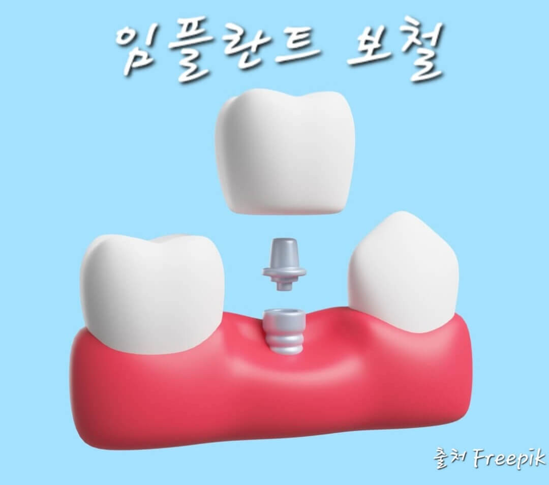 임플란트 보철