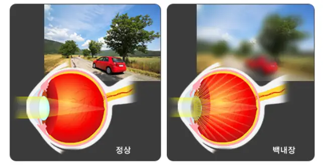 장정상신-백내장-눈
