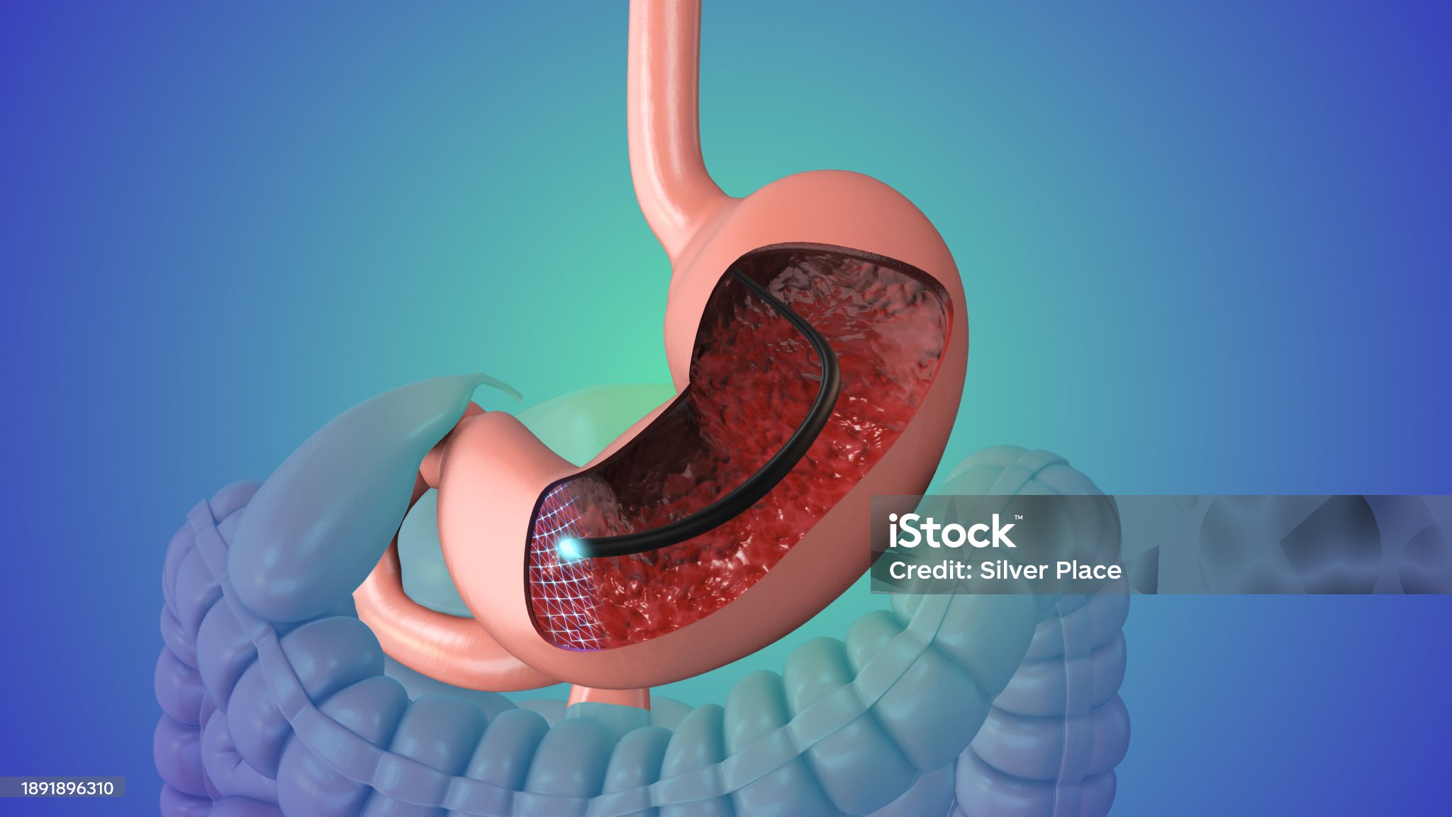 위염-관련-사진