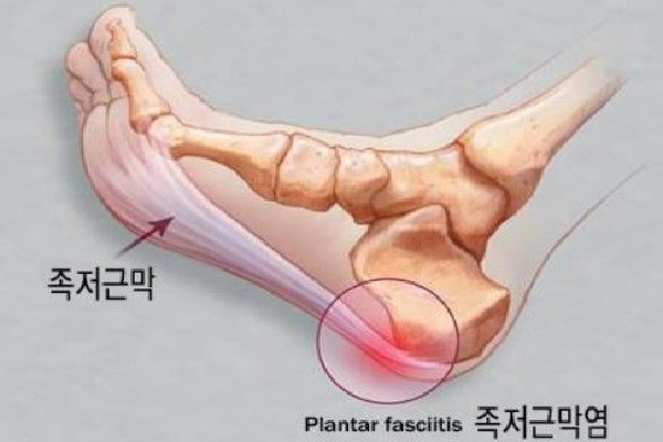 족저근막염