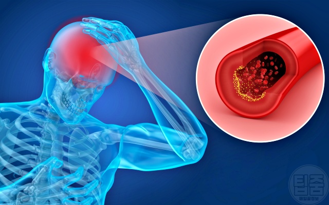 뇌졸중 환자 공통점 복부비만 중성지방 콜레스테롤 혈당 고혈압