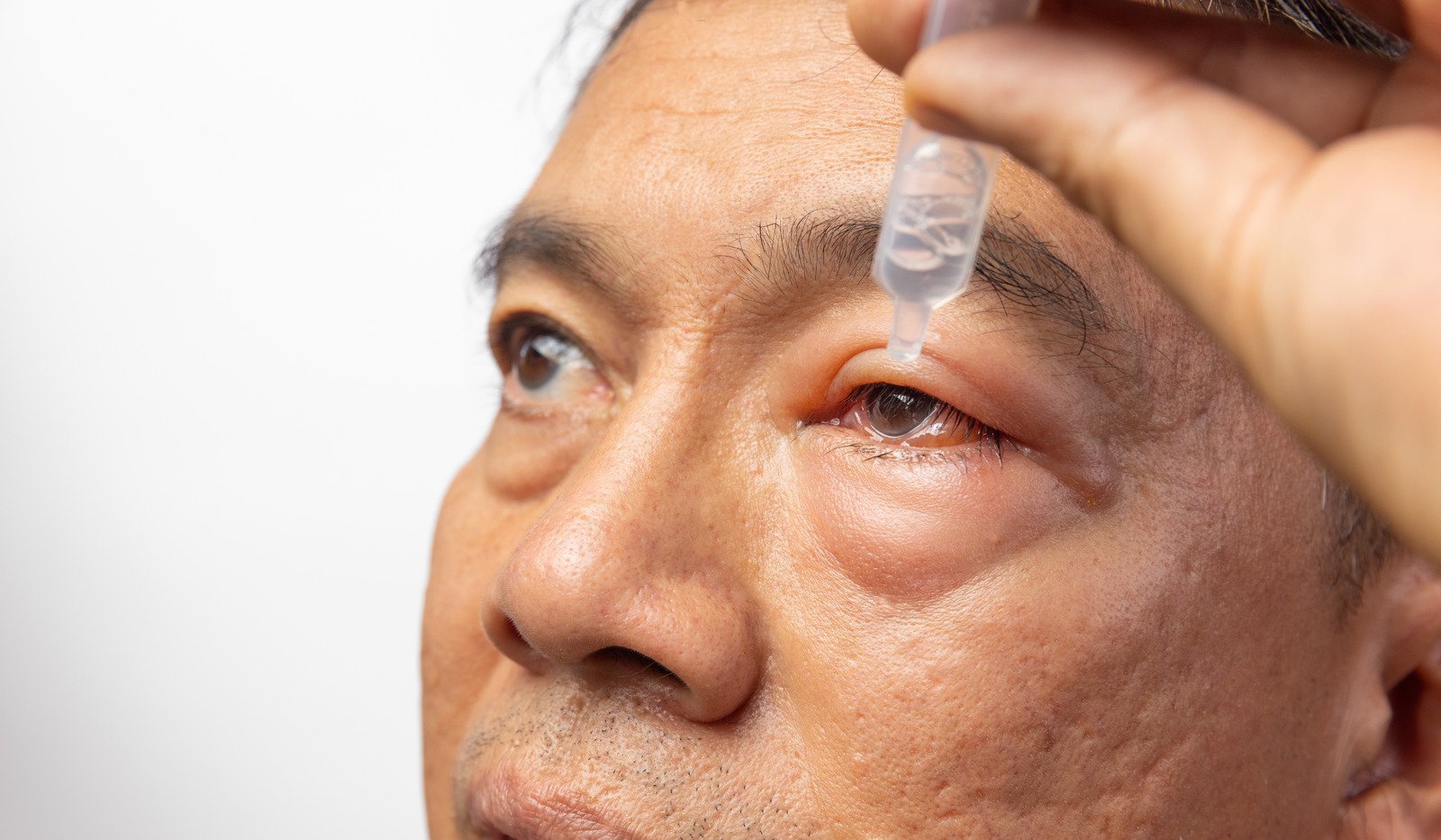 항염증제(스테로이드 및 비스테로이드성) 점안액: 염증 완화