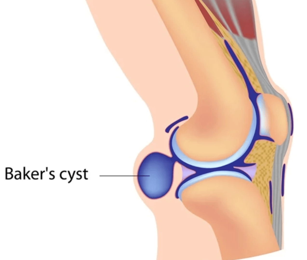 베이커 낭종 위치