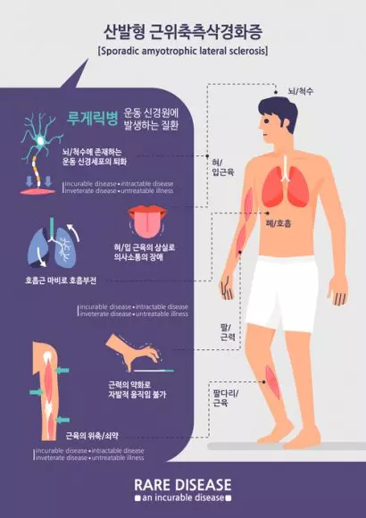 루게릭병