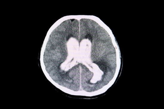 두개내압 상승(Increased Intracranial Pressure, ICP) &ndash; 뇌압 증가로 인한 시신경 압박과 증상