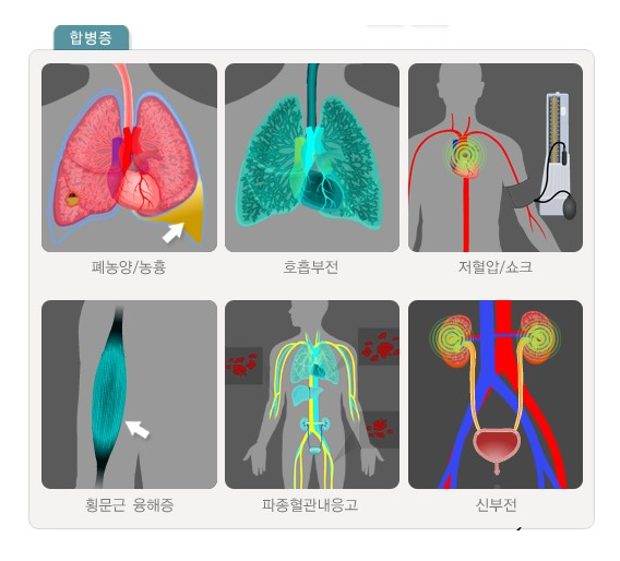 레지오넬라증 증상과 원인, 치료법