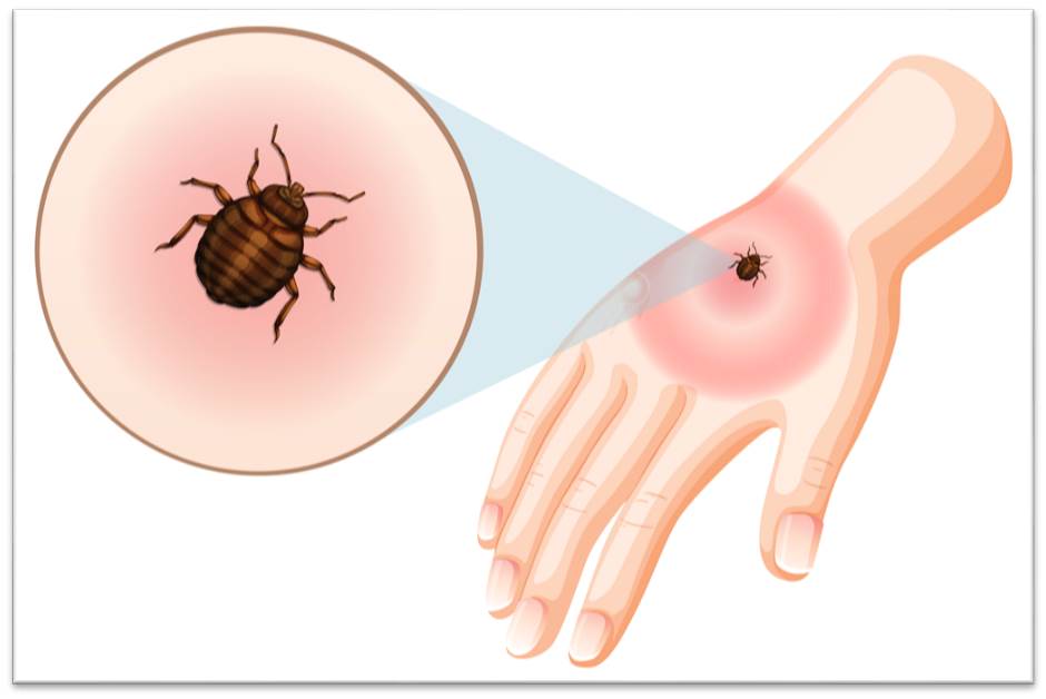 빈대 물린자국, 빈대 치료방법, 빈대 퇴치법 및 예방법