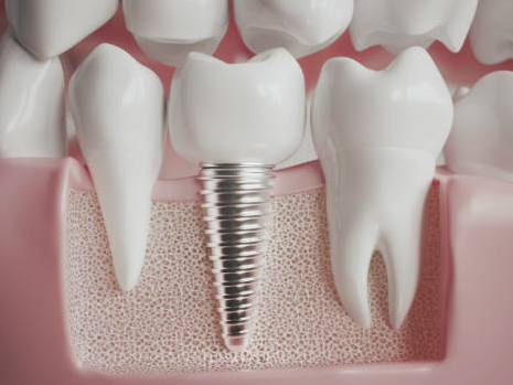 임플란트 가격 확인 최저가 확인 시술기간 (최신)