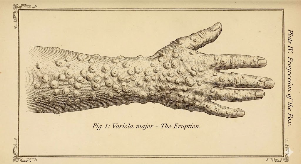 온몸을 뒤덮는 천연두의 공포