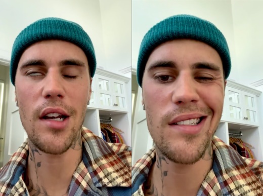 저스틴비버-램지헌트-증후군