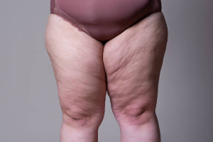 Let's Understand the Causes of Lower Body Obesity.