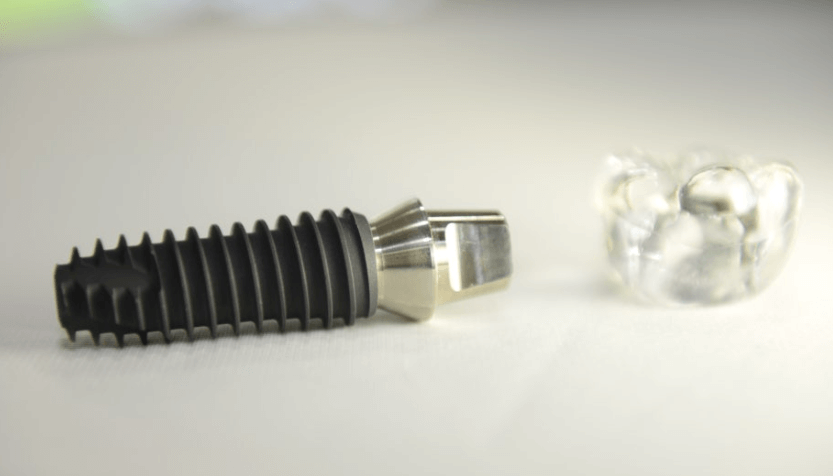 임플란트 보철재 비교 총정리 (Gold PFM Zirconia )