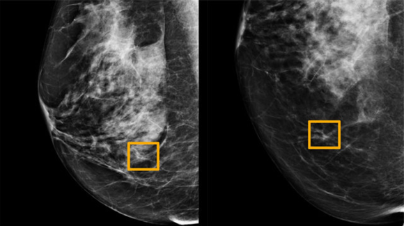인공지능이 판독한 유방암