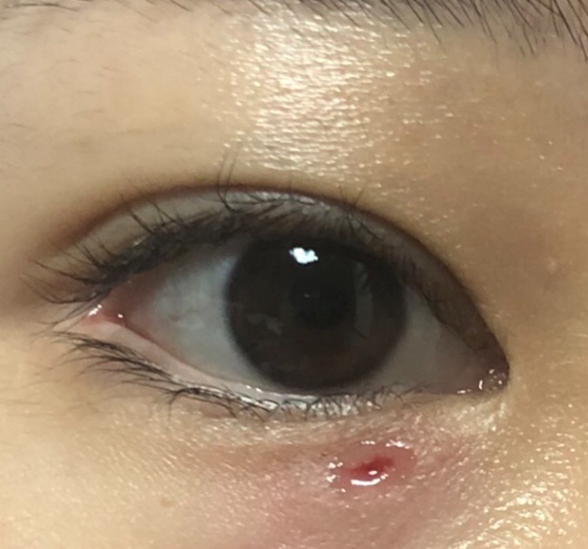 비립종 없애는 방법