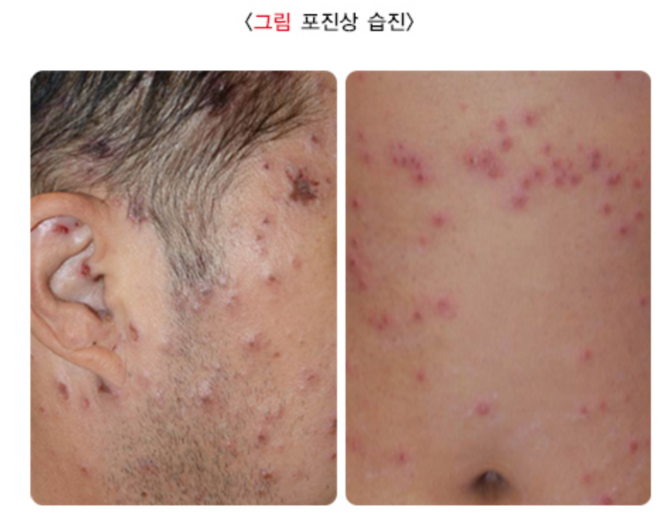 포진상습진-단순포진