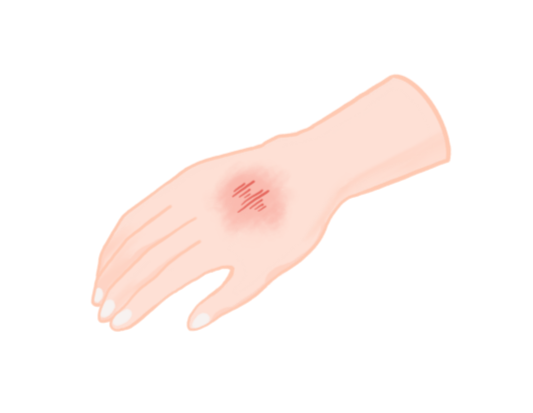 상처의 종류별 특징과 치료법, 이것만 알면 끝!