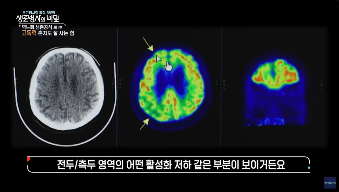 생로병사의 비밀 고독력