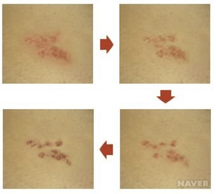 대상포진 진행과정