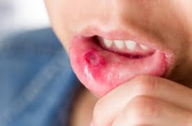 혓바늘 없애는 방법