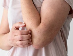 피부 붉은반점 10