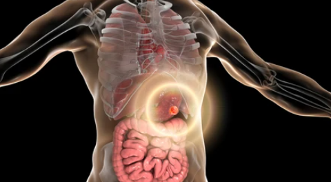 위암 환자 피해야할 음식